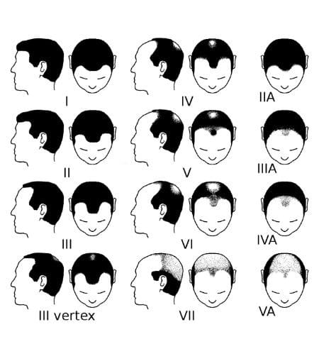 Norwood Scale