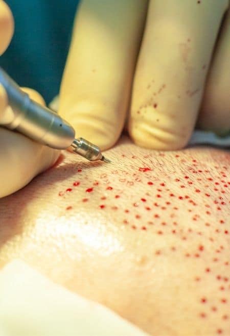 FUE hair transplant