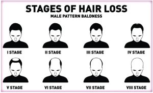 hair loss classification chart