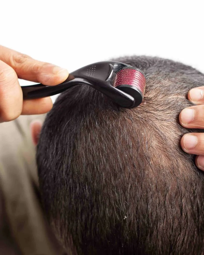 Meso Treatment / Mesotherapy in Delhi