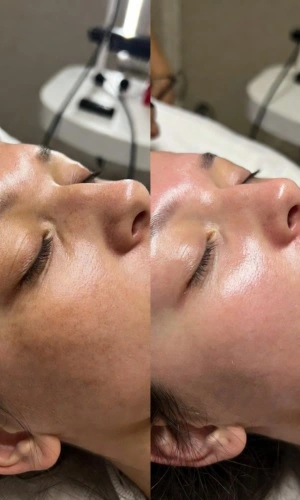 before after - chemical peels