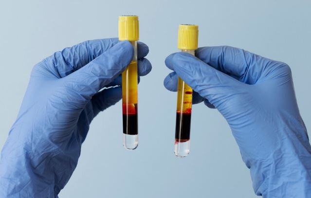 Prp treatment in south Delhi